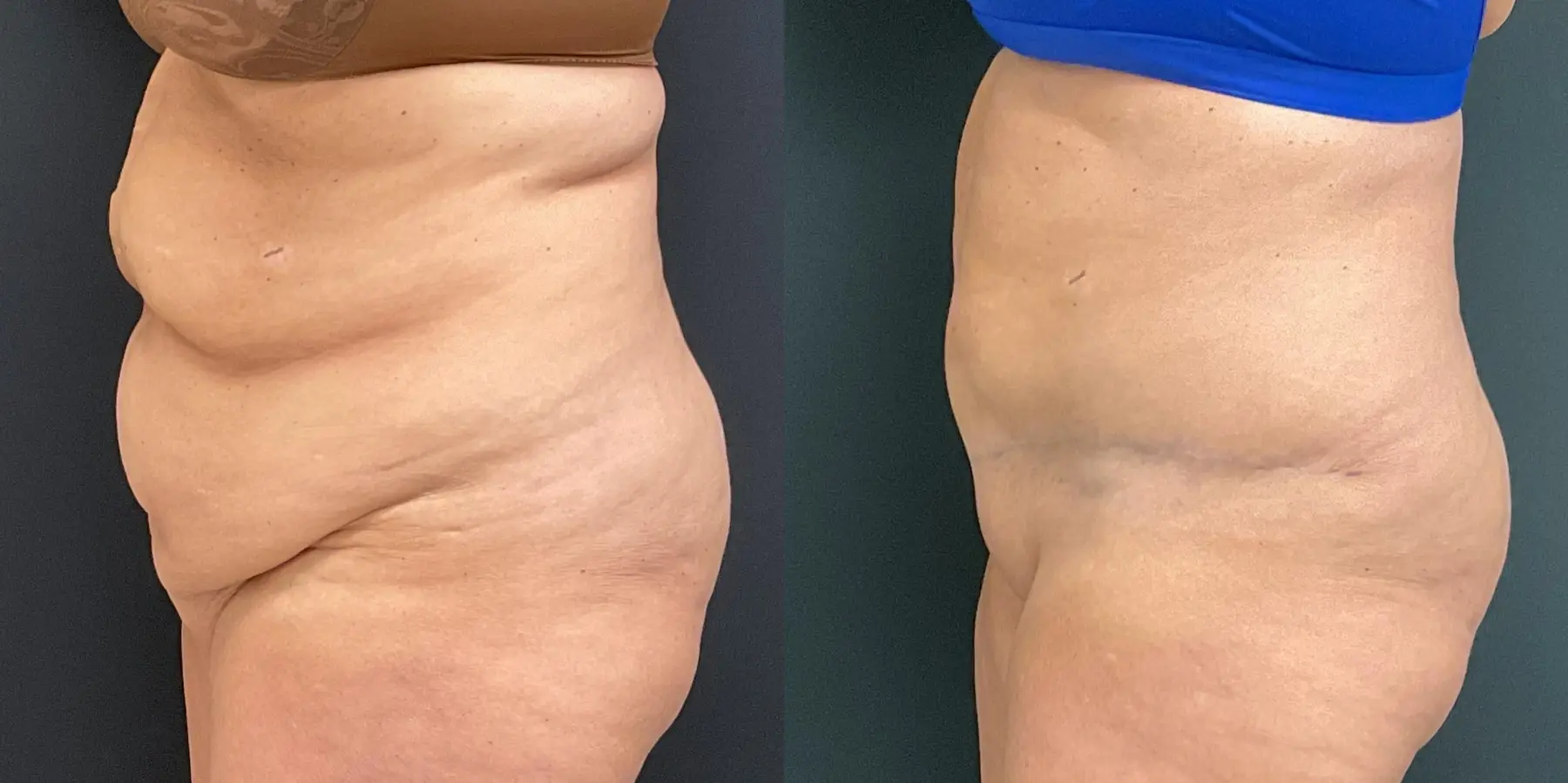 Tummy Tuck: Patient 8 - Before and After 4