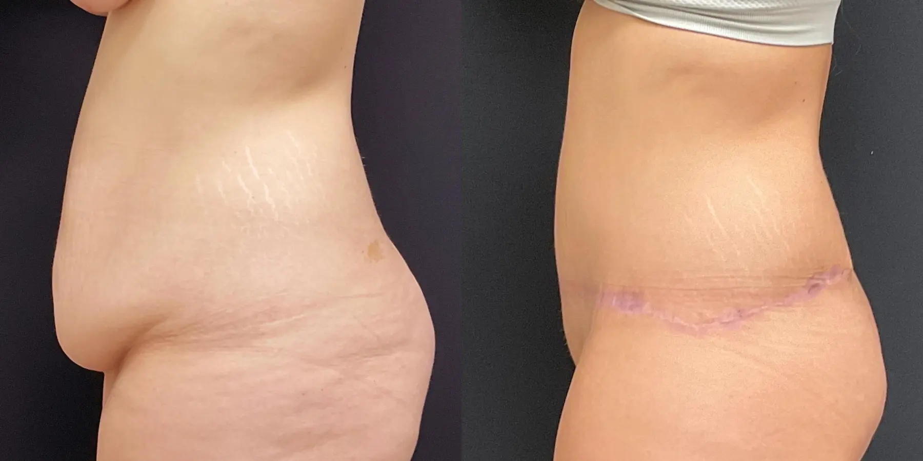 Tummy Tuck: Patient 2 - Before and After 4