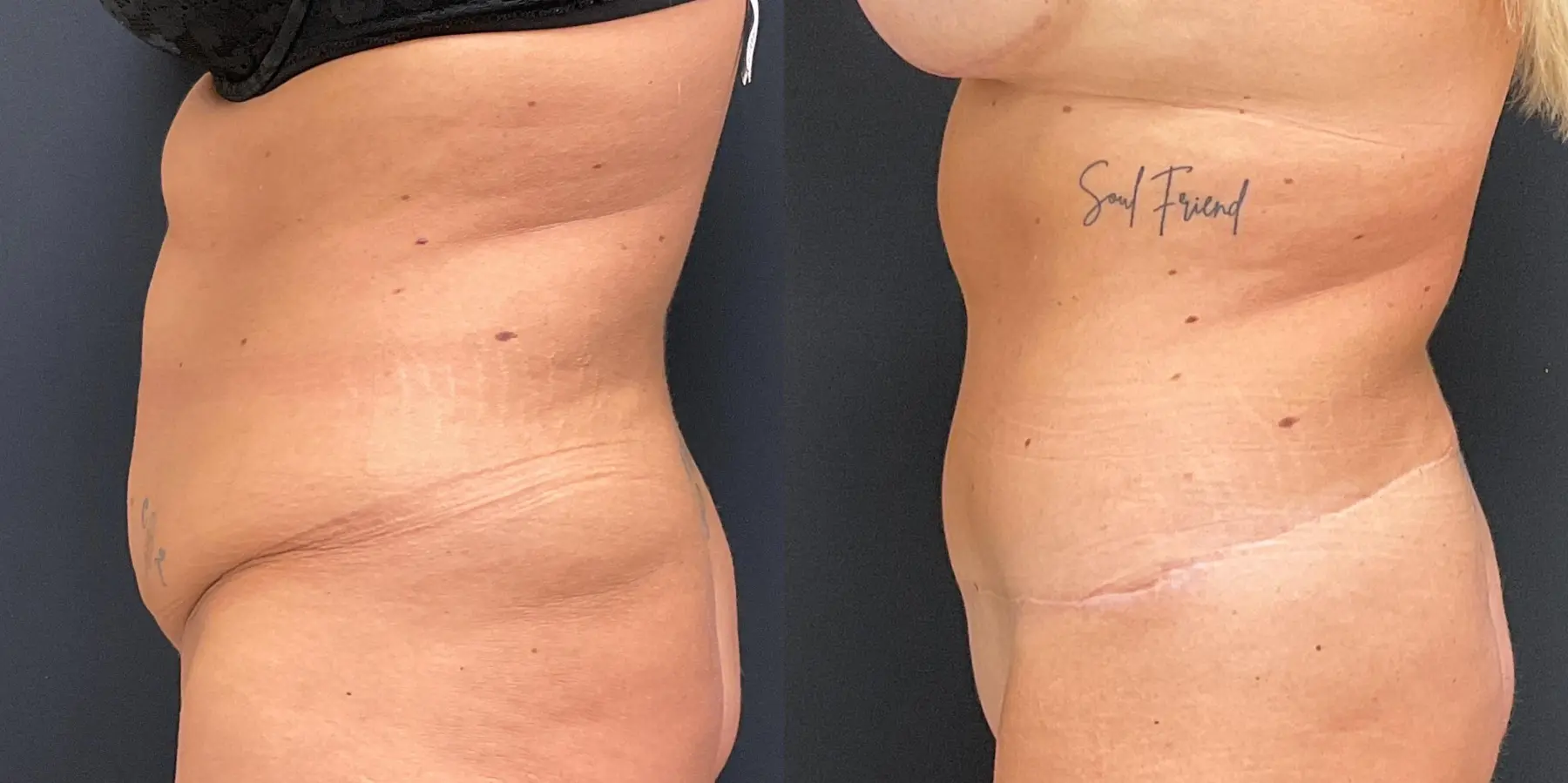 Tummy Tuck: Patient 4 - Before and After 4