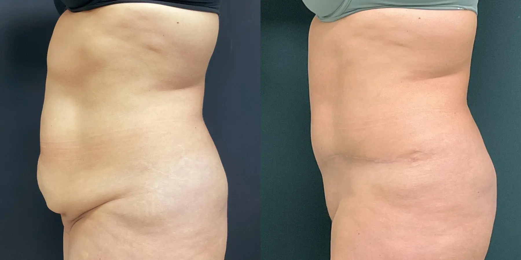 Tummy Tuck: Patient 21 - Before and After 4