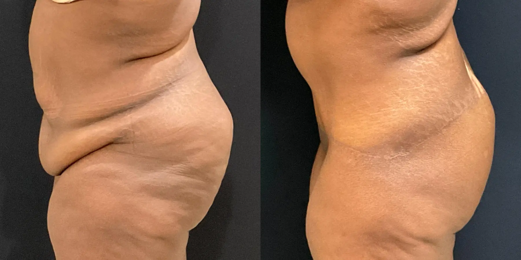 Tummy Tuck: Patient 3 - Before and After 5