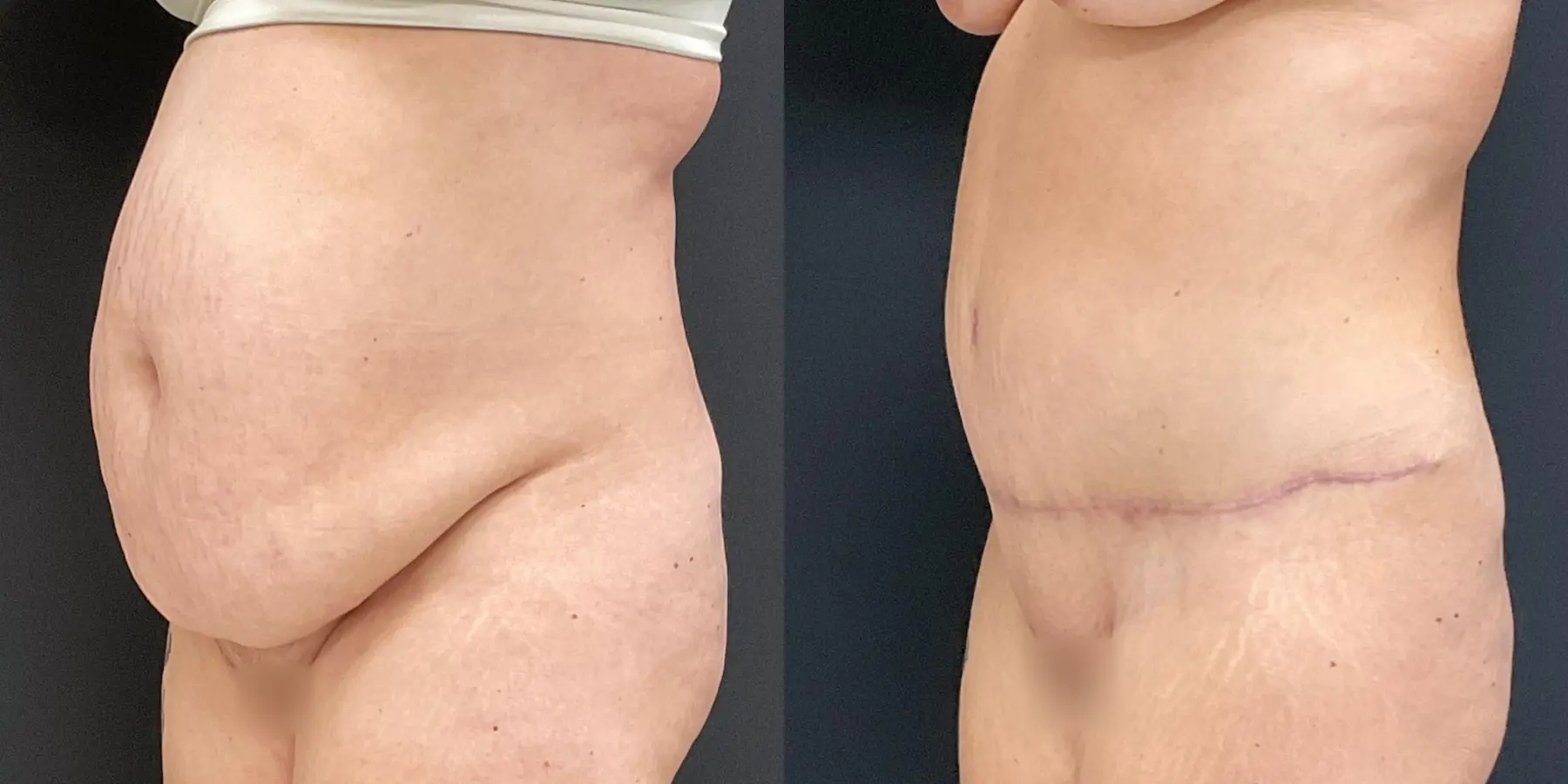 Tummy Tuck: Patient 14 - Before and After 2