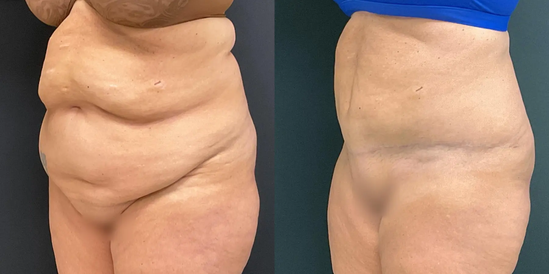 Tummy Tuck: Patient 8 - Before and After 2