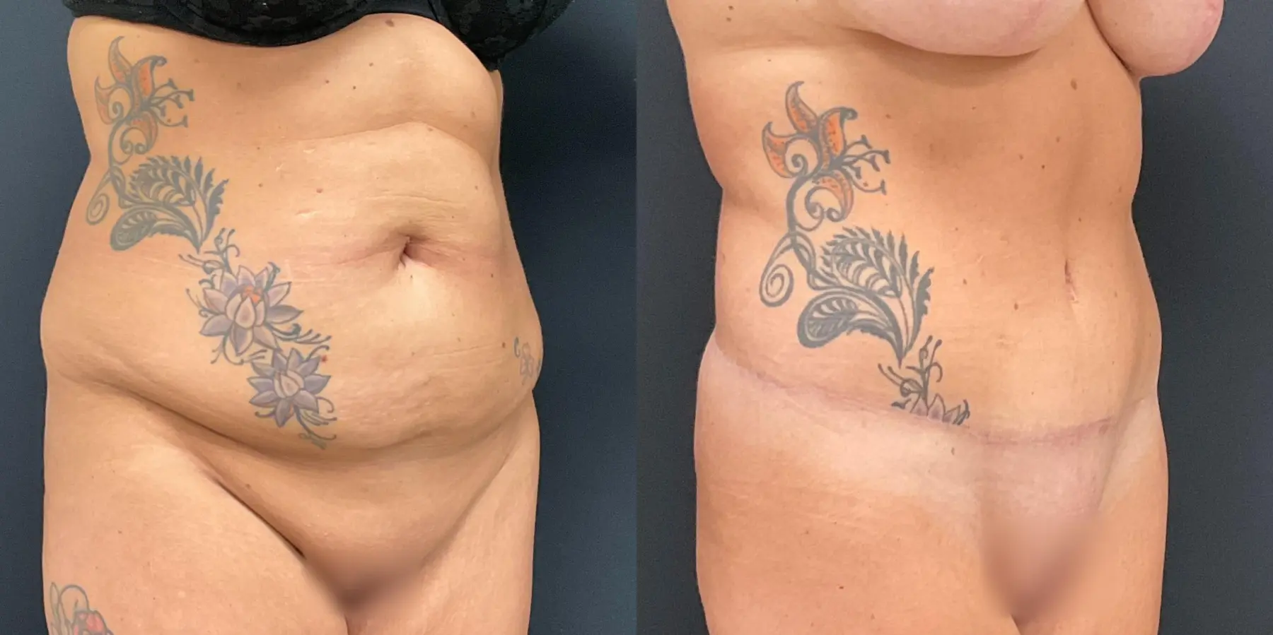 Tummy Tuck: Patient 4 - Before and After 3