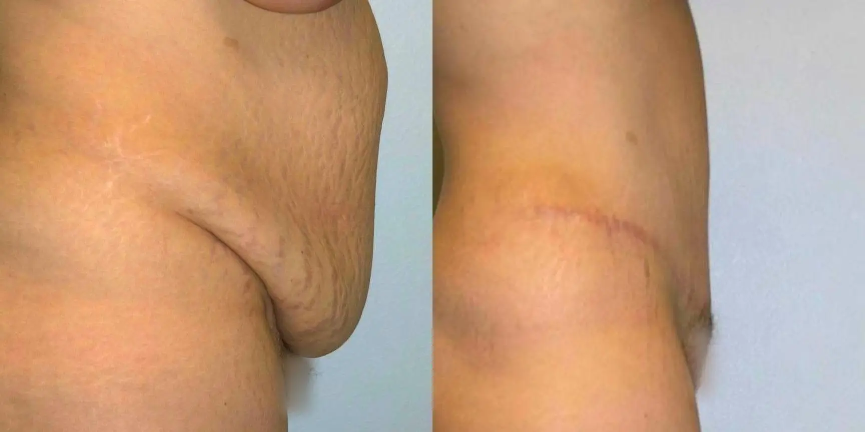 Tummy Tuck: Patient 15 - Before and After 3