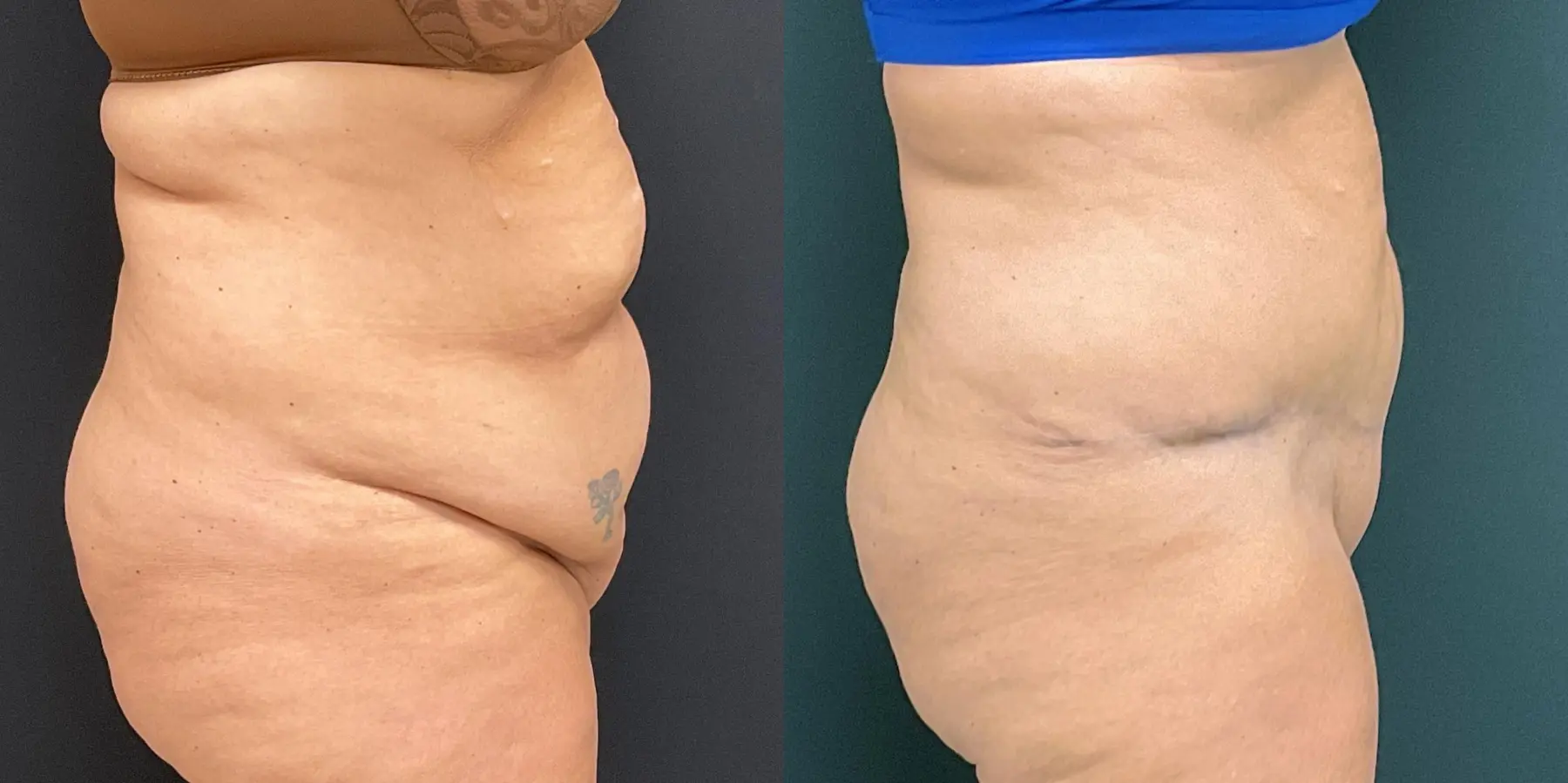 Tummy Tuck: Patient 8 - Before and After 5