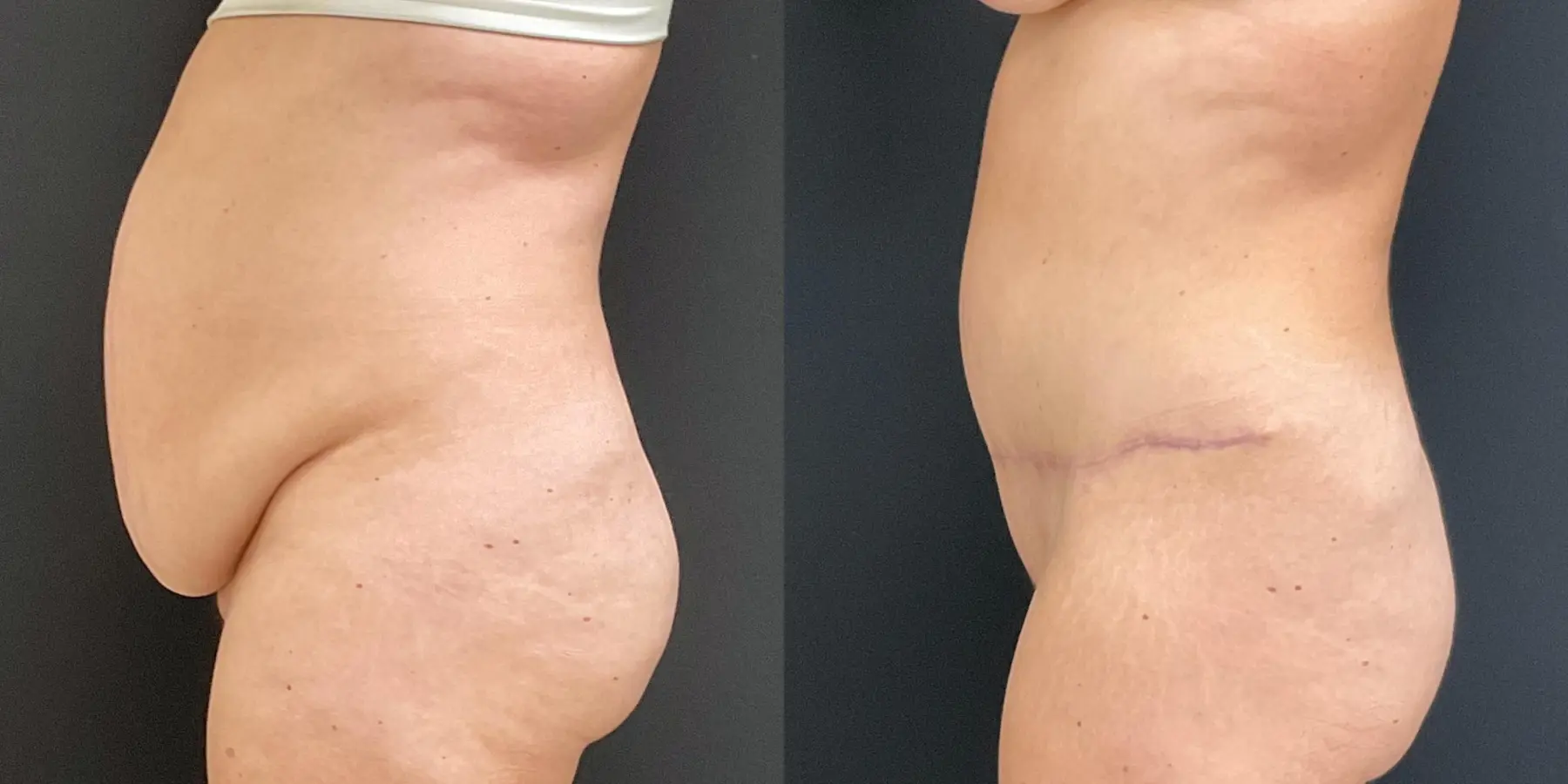 Tummy Tuck: Patient 14 - Before and After 4