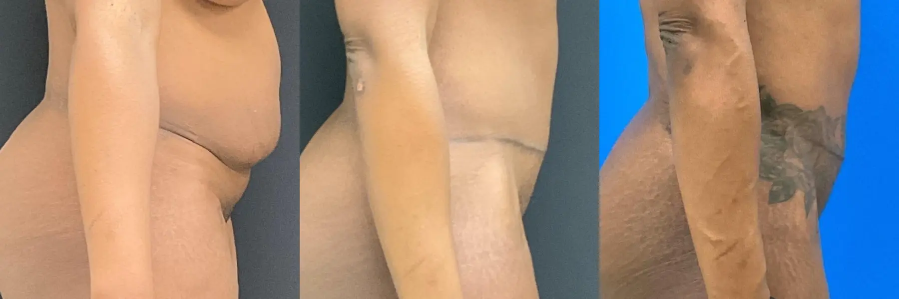 Tummy Tuck: Patient 10 - Before and After 5