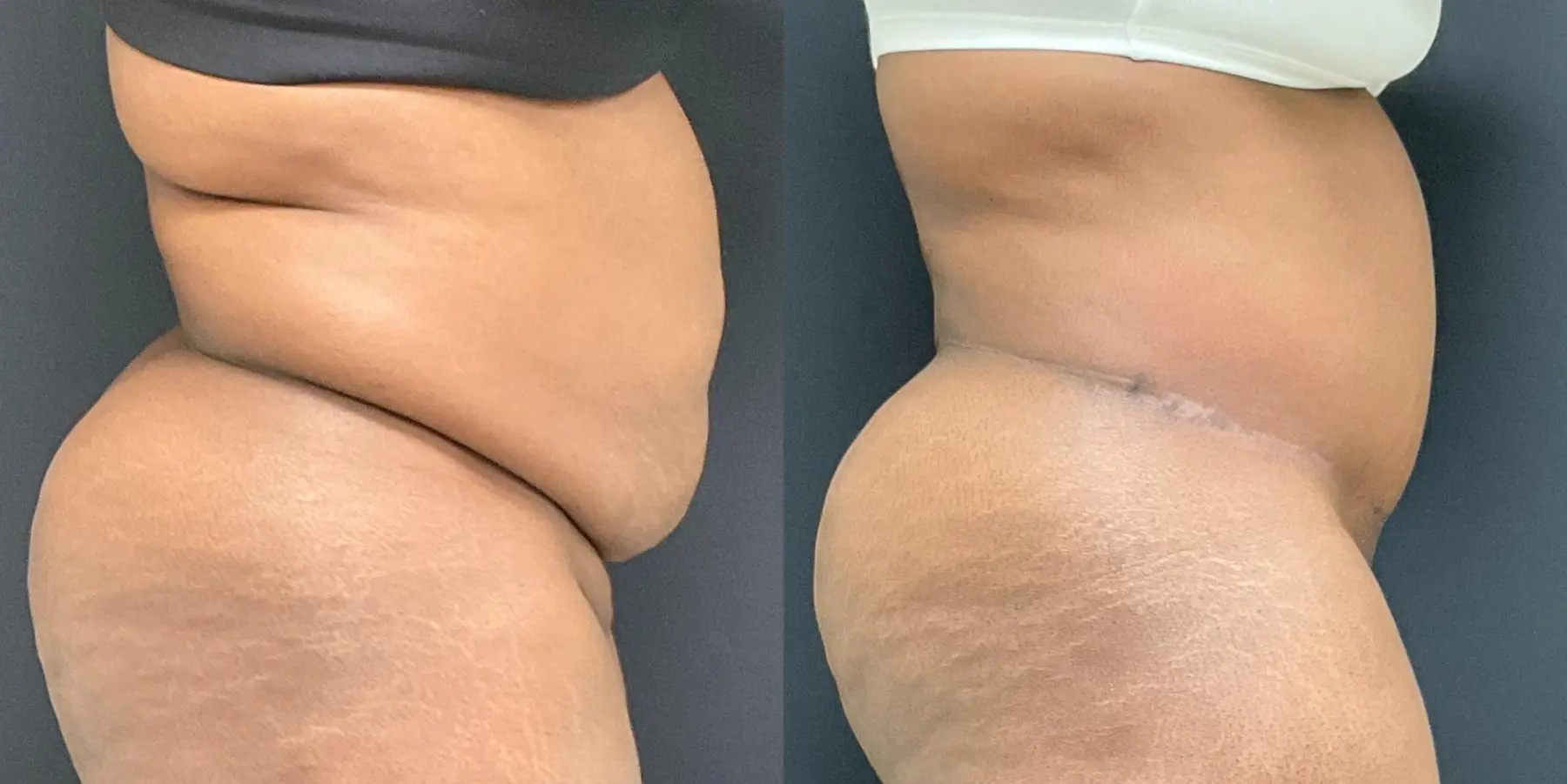 Tummy Tuck: Patient 18 - Before and After 5