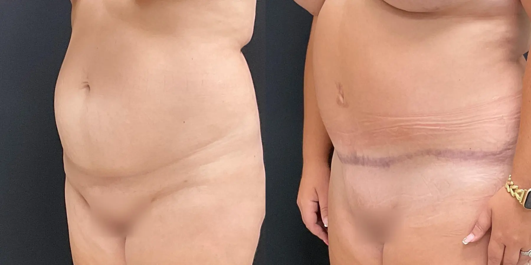 Tummy Tuck: Patient 16 - Before and After 2