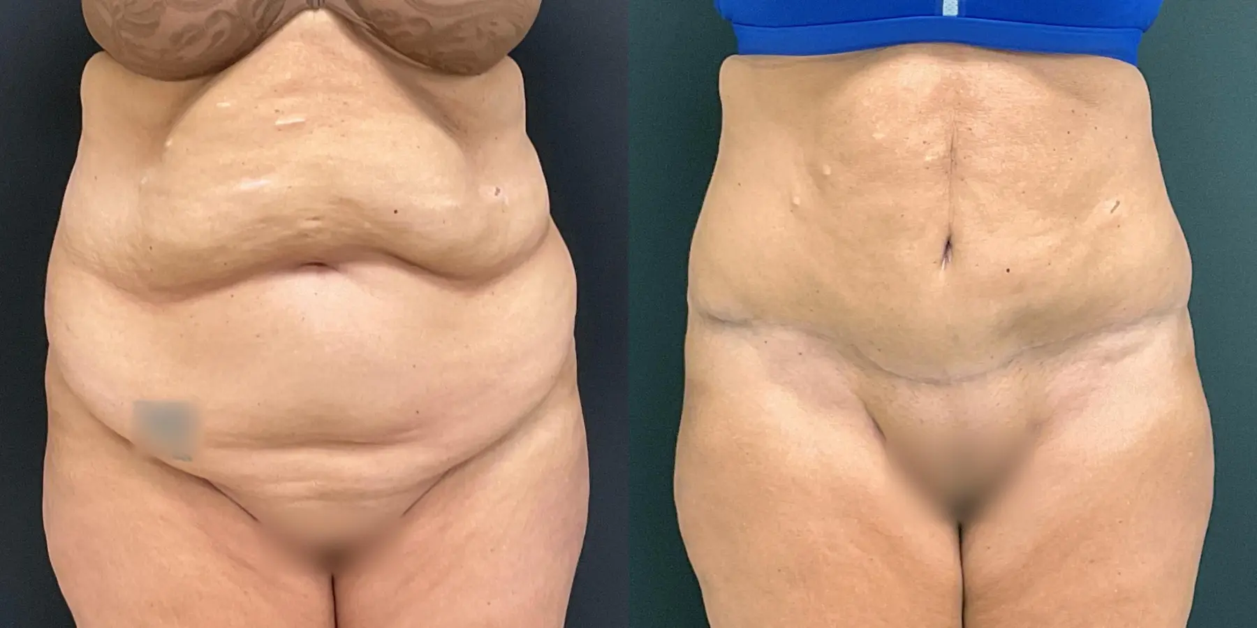 Tummy Tuck: Patient 17 - Before and After  