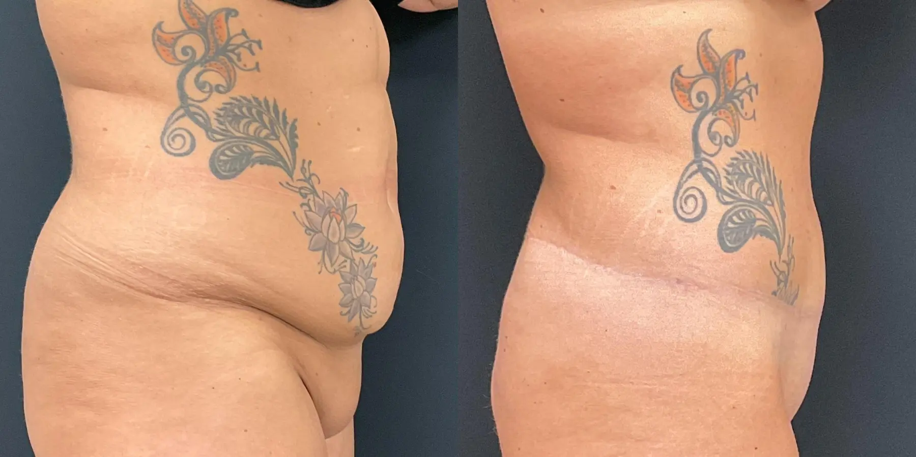 Tummy Tuck: Patient 4 - Before and After 5