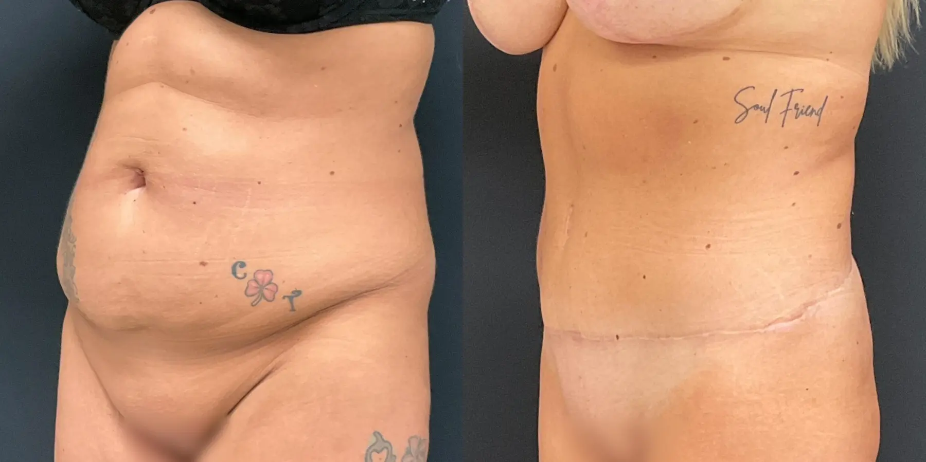 Tummy Tuck: Patient 4 - Before and After 2