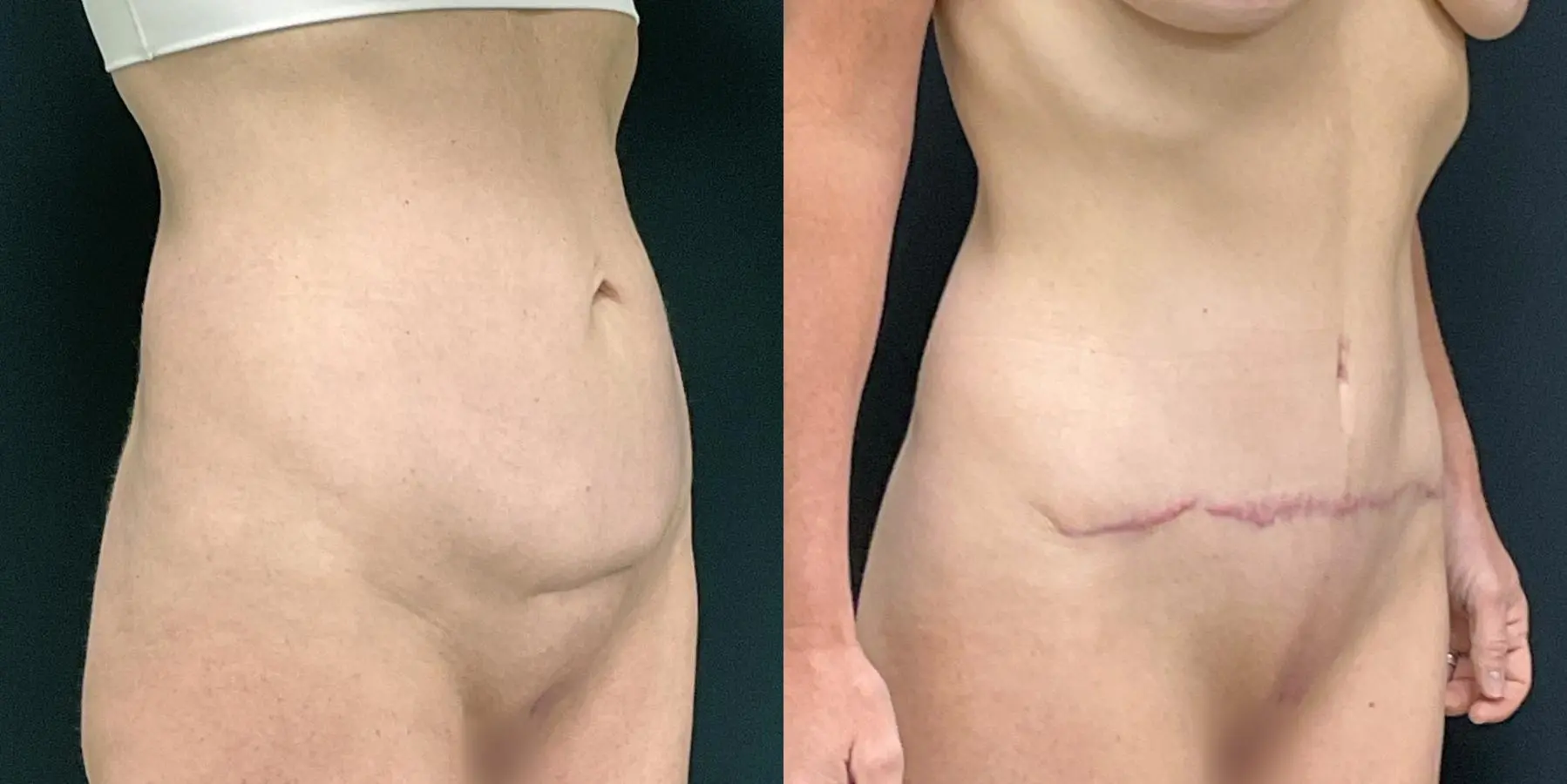 Tummy Tuck: Patient 13 - Before and After 3