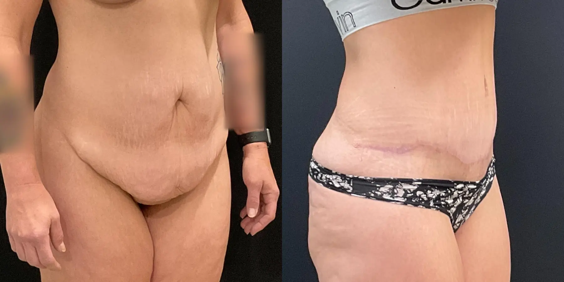 Tummy Tuck: Patient 15 - Before and After 3