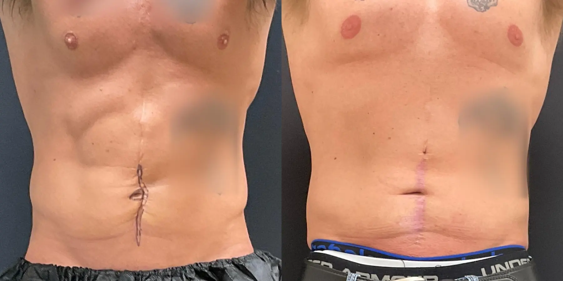 Tummy Tuck For Men: Patient 2 - Before and After 1