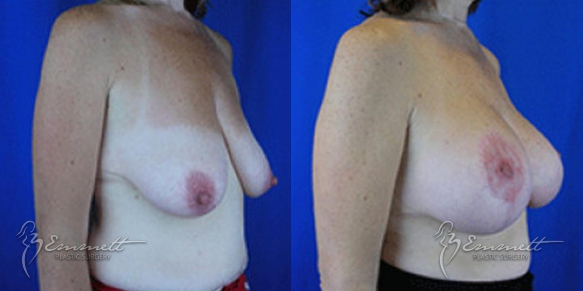 Breast Augmentation: Patient 6 - Before and After  