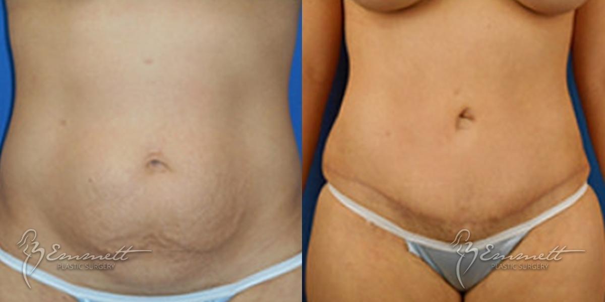 Tummy Tuck: Patient 1 - Before and After  