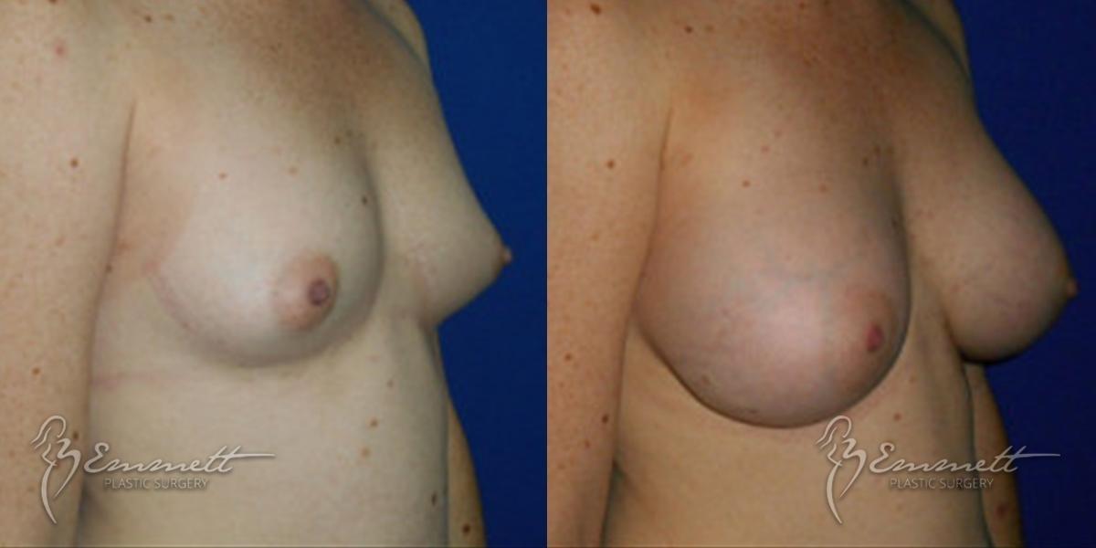 Breast Augmentation: Patient 4 - Before and After  