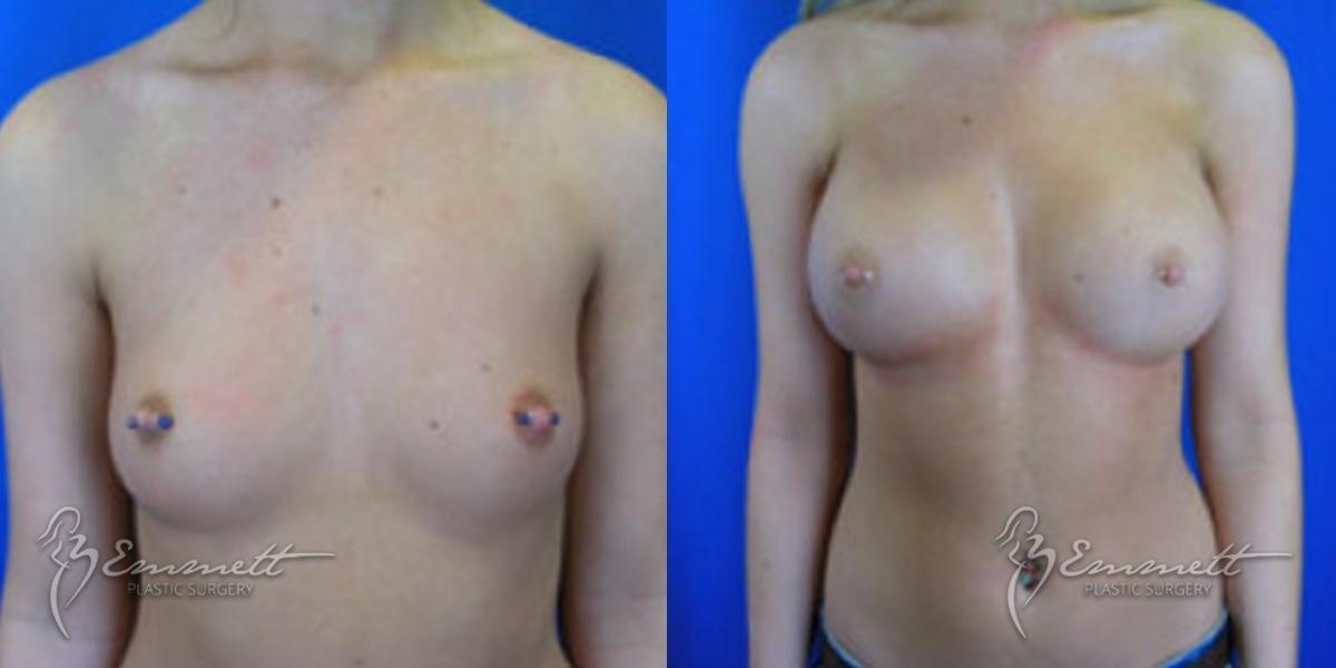 Breast Augmentation: Patient 9 - Before and After  