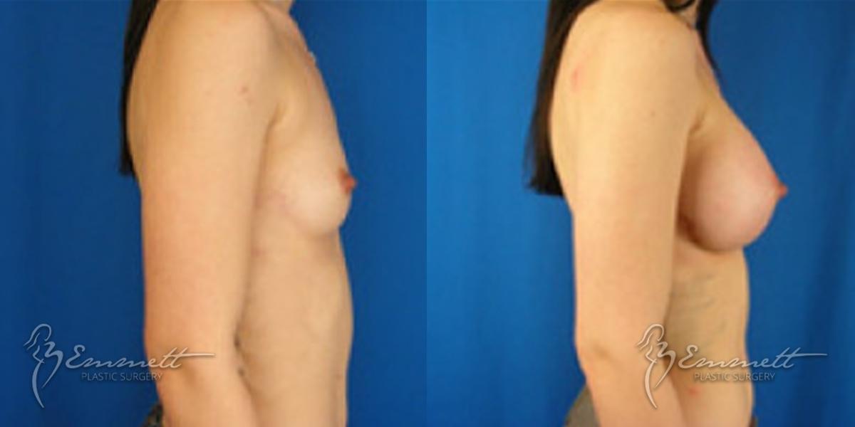 Breast Augmentation: Patient 10 - Before and After  