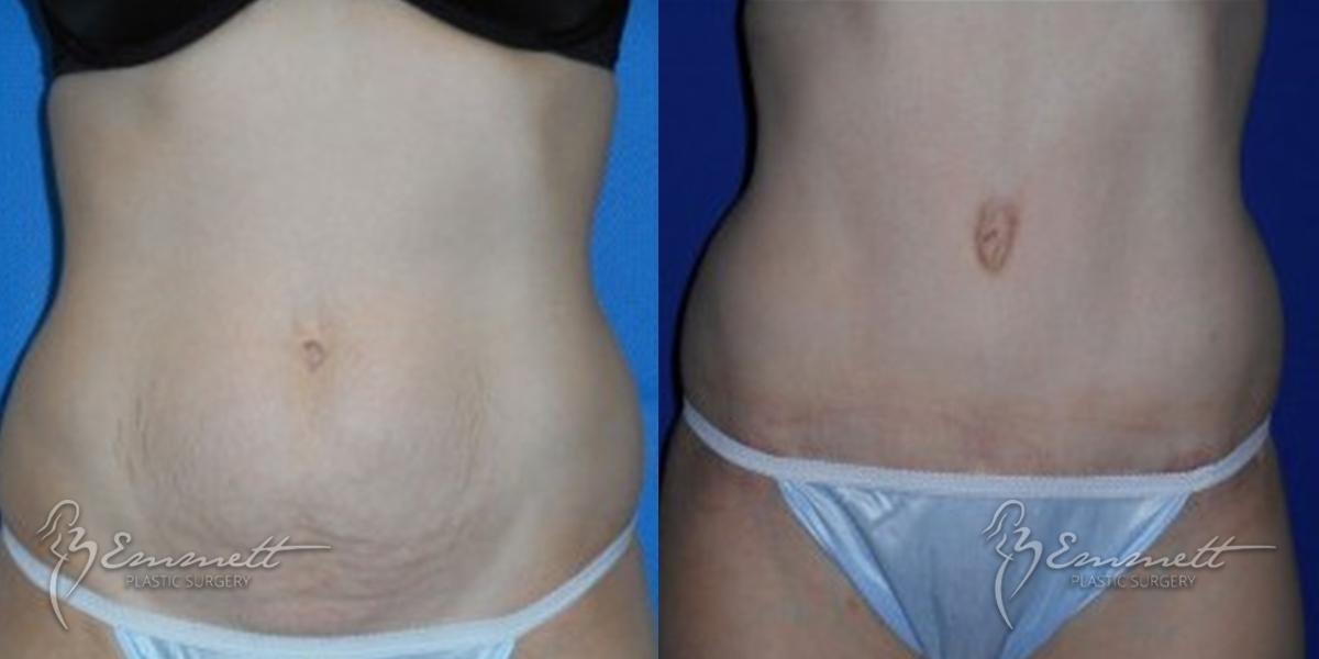 Tummy Tuck: Patient 5 - Before and After  