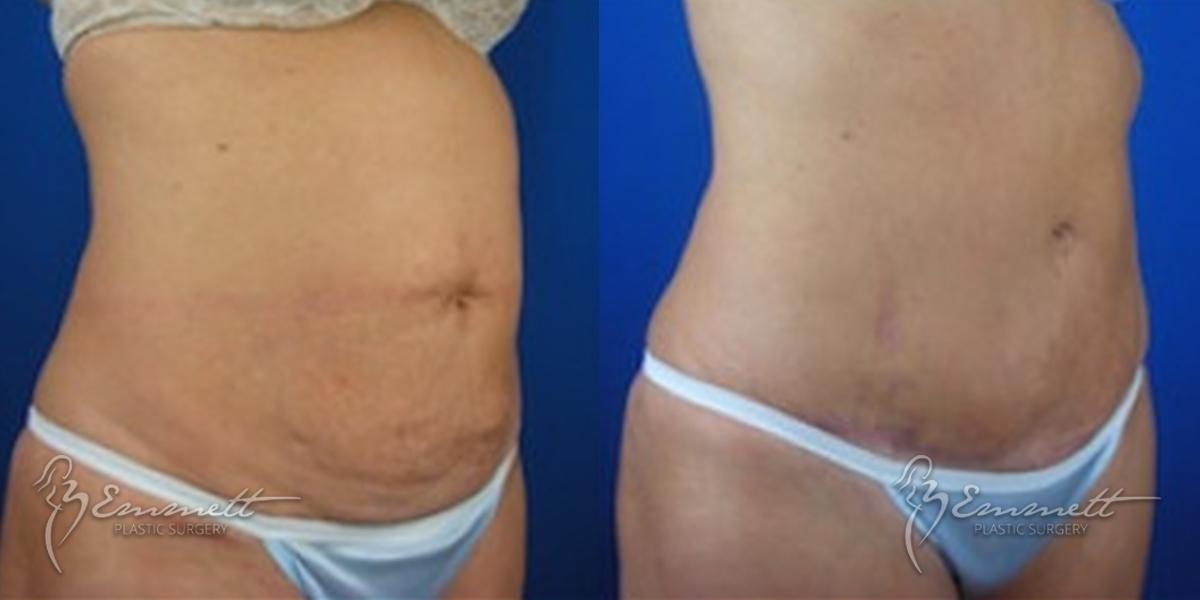 Tummy Tuck: Patient 2 - Before and After  