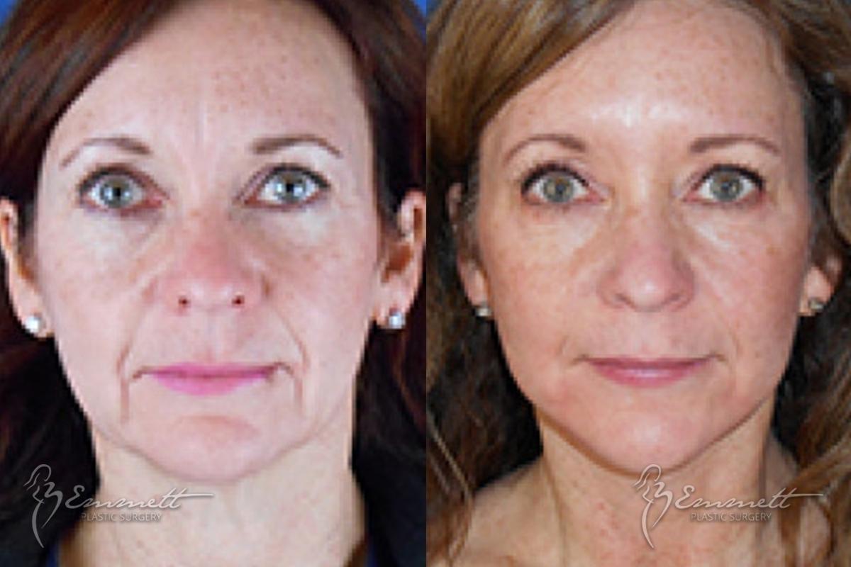 Facelift & Neck Lift: Patient 3 - Before and After  