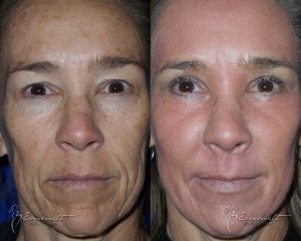 J-Plasma: Patient 6 - Before and After  