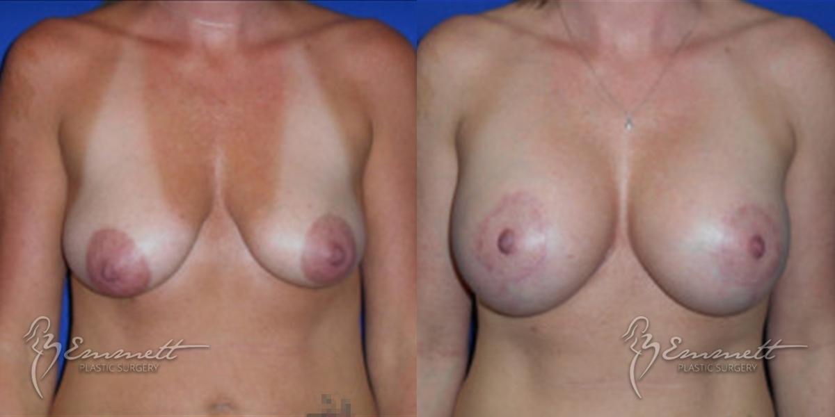 Breast Lift: Patient 3 - Before and After  