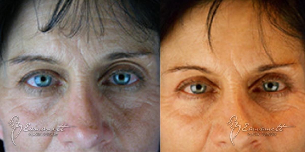 Blepharoplasty: Patient 2 - Before and After  