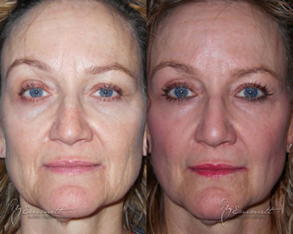 J-Plasma: Patient 1 - Before and After  