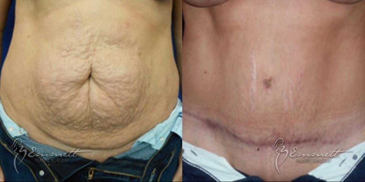 Tummy Tuck: Patient 8 - Before and After  