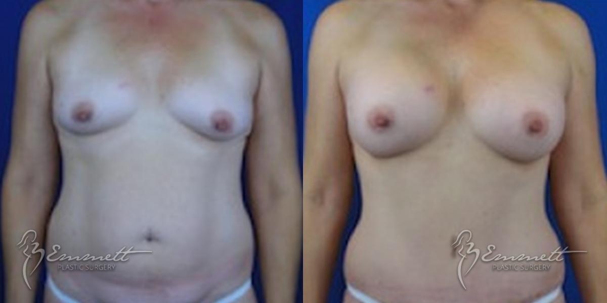 Breast Augmentation: Patient 2 - Before and After  