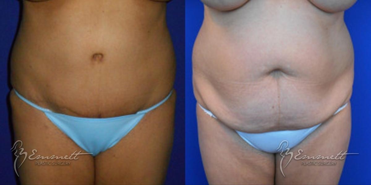 Tummy Tuck: Patient 10 - Before and After  