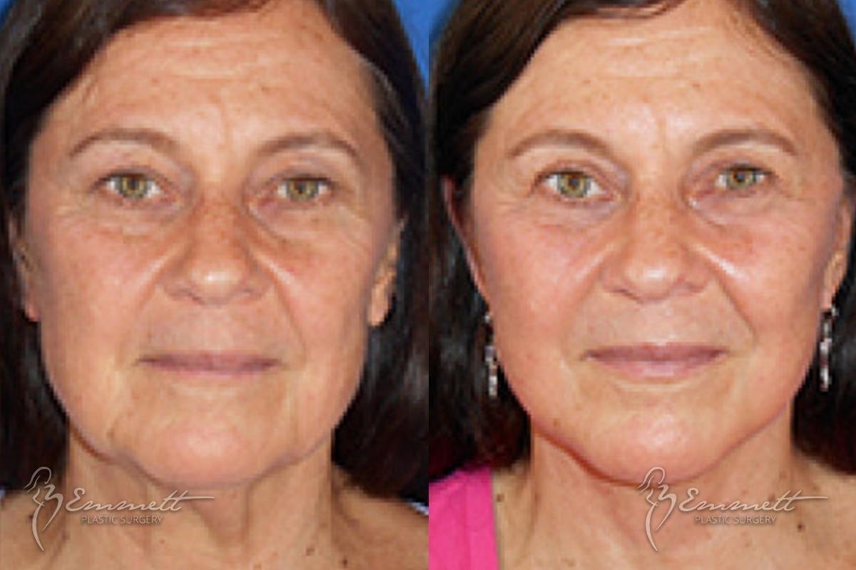 Facelift & Neck Lift: Patient 6 - Before and After  