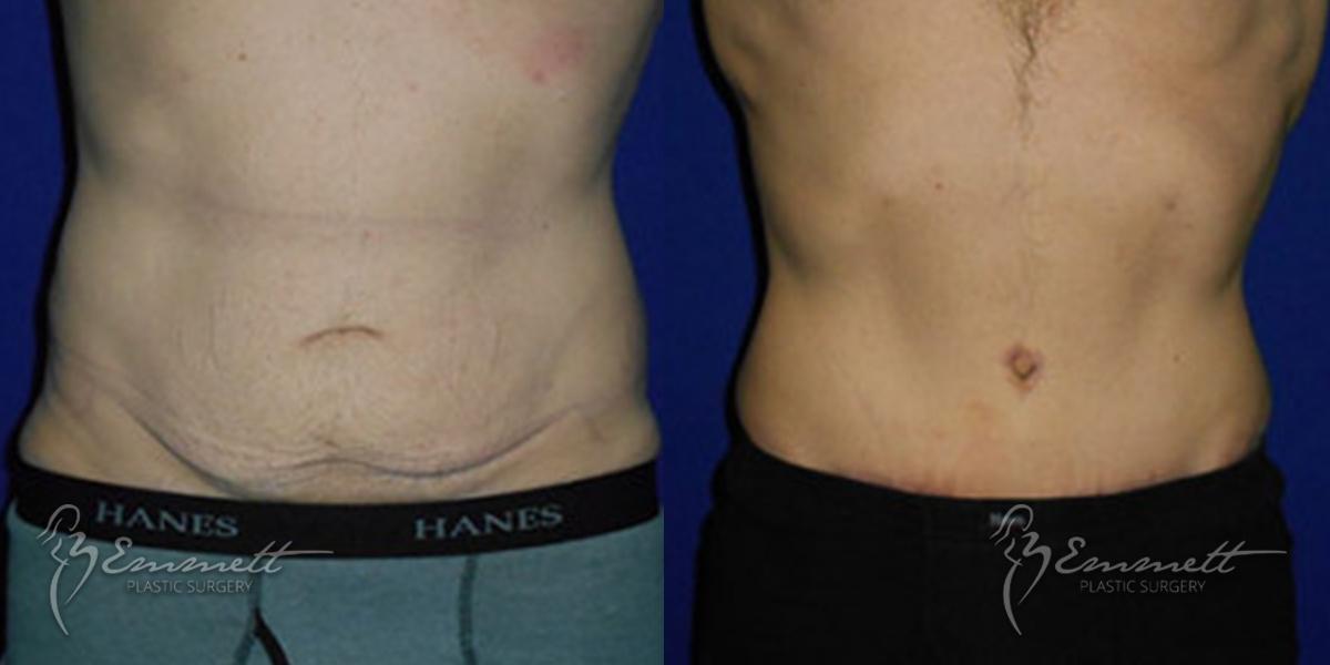 Tummy Tuck: Patient 9 - Before and After  