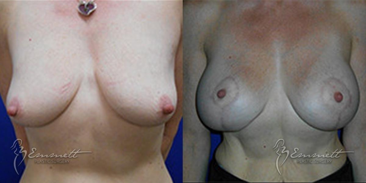 Breast Lift: Patient 5 - Before and After  