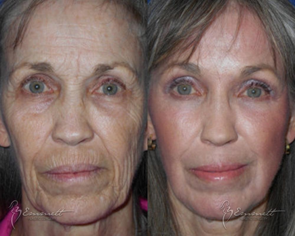 J-Plasma: Patient 2 - Before and After  