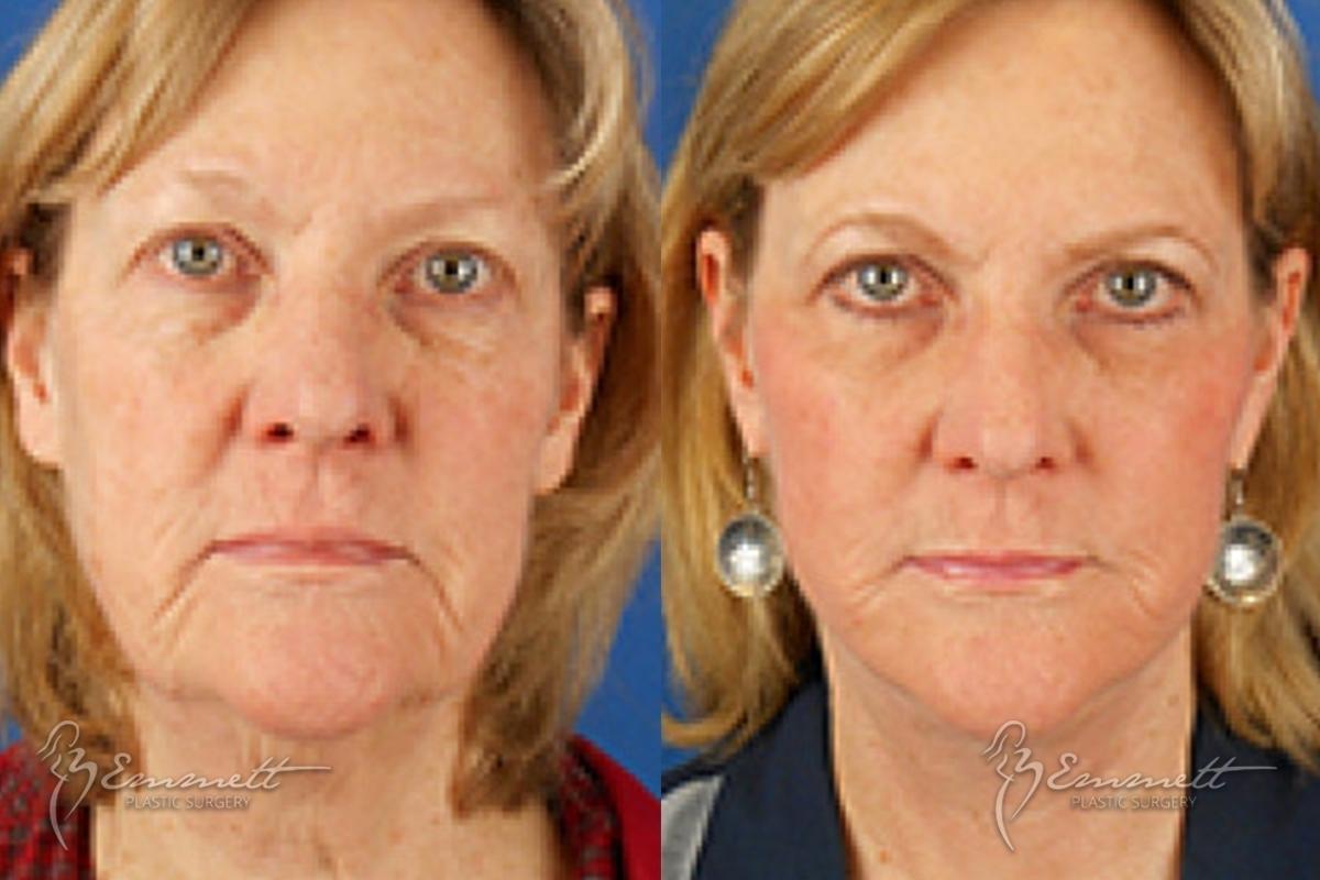 Facelift & Neck Lift: Patient 4 - Before and After  