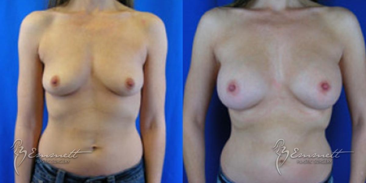 Breast Augmentation: Patient 8 - Before and After  