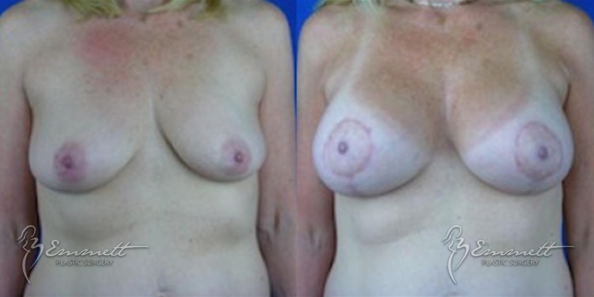 Breast Lift: Patient 1 - Before and After  