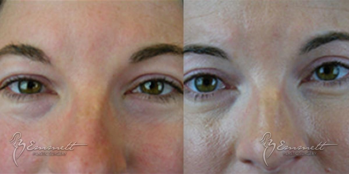 Blepharoplasty: Patient 1 - Before and After  