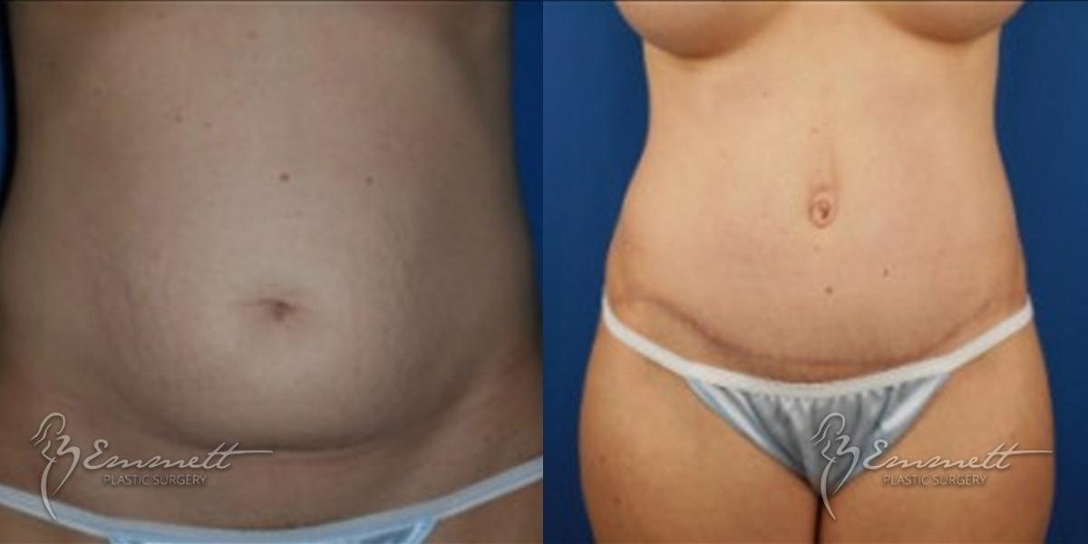 Tummy Tuck: Patient 6 - Before and After  