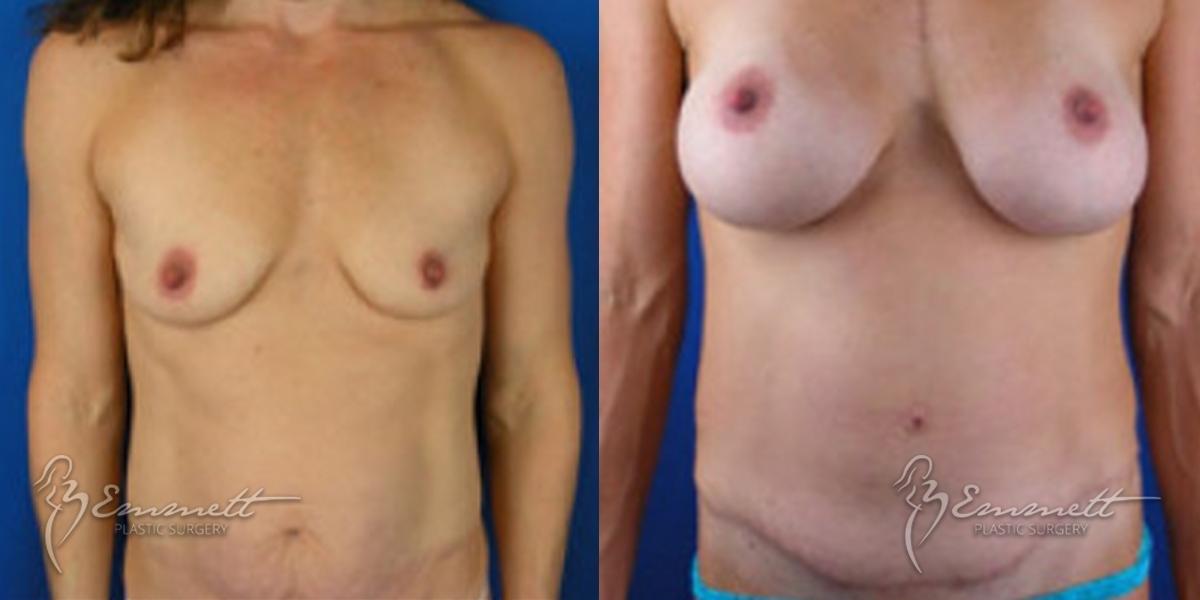 Breast Augmentation: Patient 7 - Before and After  