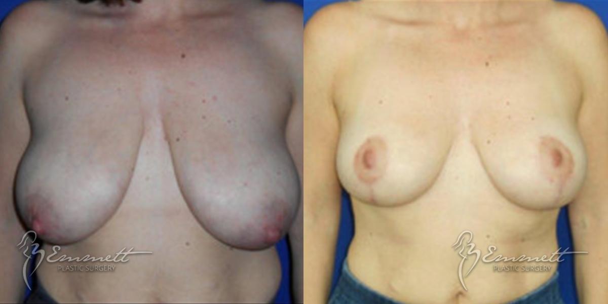 Breast Lift: Patient 4 - Before and After  