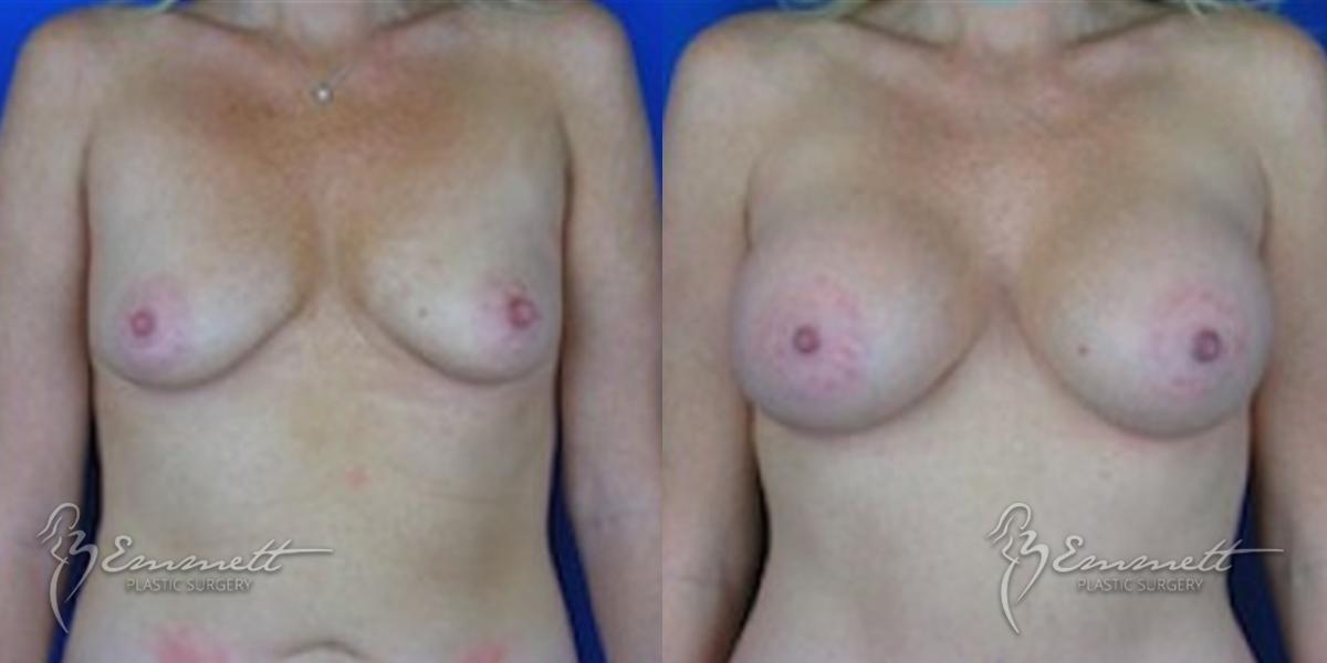 Breast Augmentation: Patient 1 - Before and After  