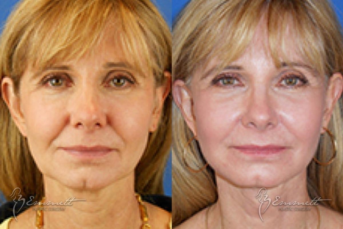 Facelift & Neck Lift: Patient 5 - Before and After  