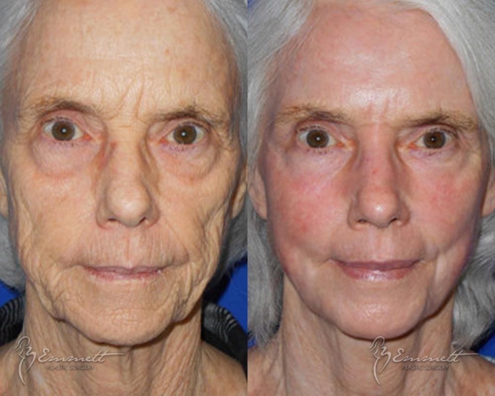 J-Plasma: Patient 3 - Before and After  