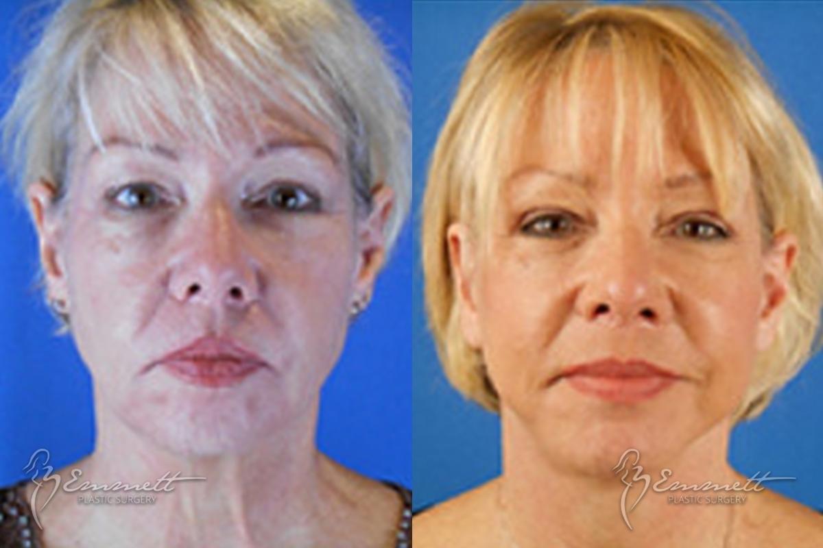 Facelift & Neck Lift: Patient 1 - Before and After  